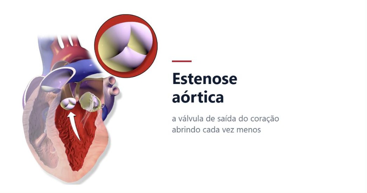 Estenose aórtica grave: dá para esperar?