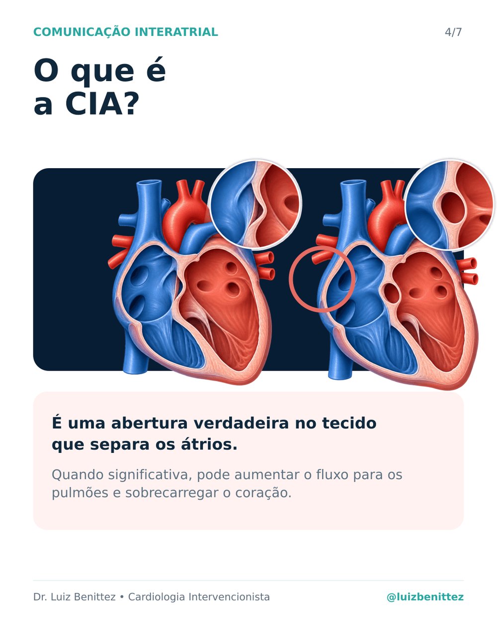 Ilustração mostrando a abertura no septo interatrial que caracteriza a comunicação interatrial