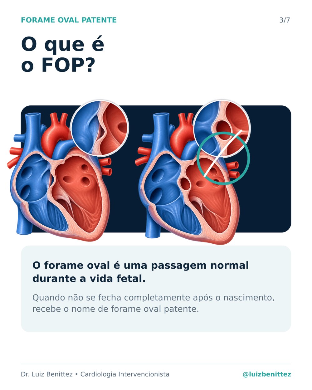 Ilustração comparando um coração com forame oval patente e um coração sem a alteração