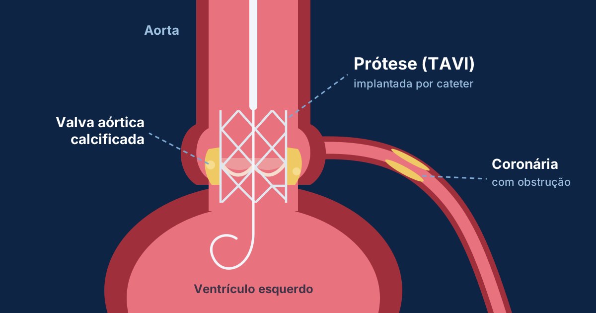 TAVI e artérias entupidas: o que tratar primeiro?