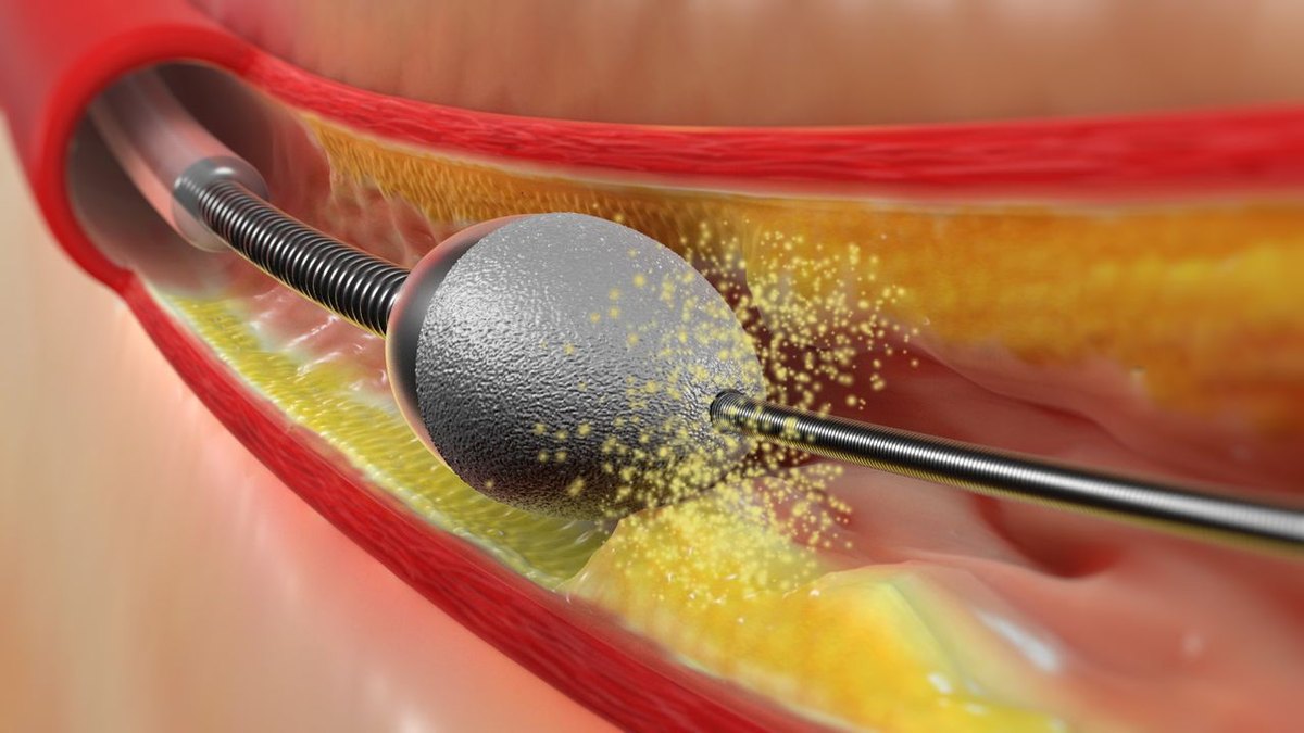 Ilustração de aterectomia rotacional: oliva diamantada pulverizando a placa calcificada dentro da artéria coronária