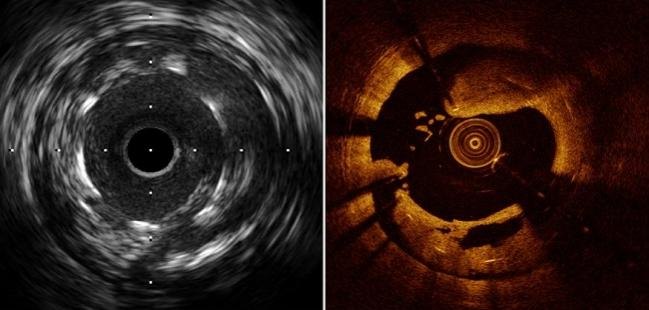 Corte transversal de artéria coronária visto por ultrassom intracoronário (IVUS) e por tomografia de coerência óptica (OCT)