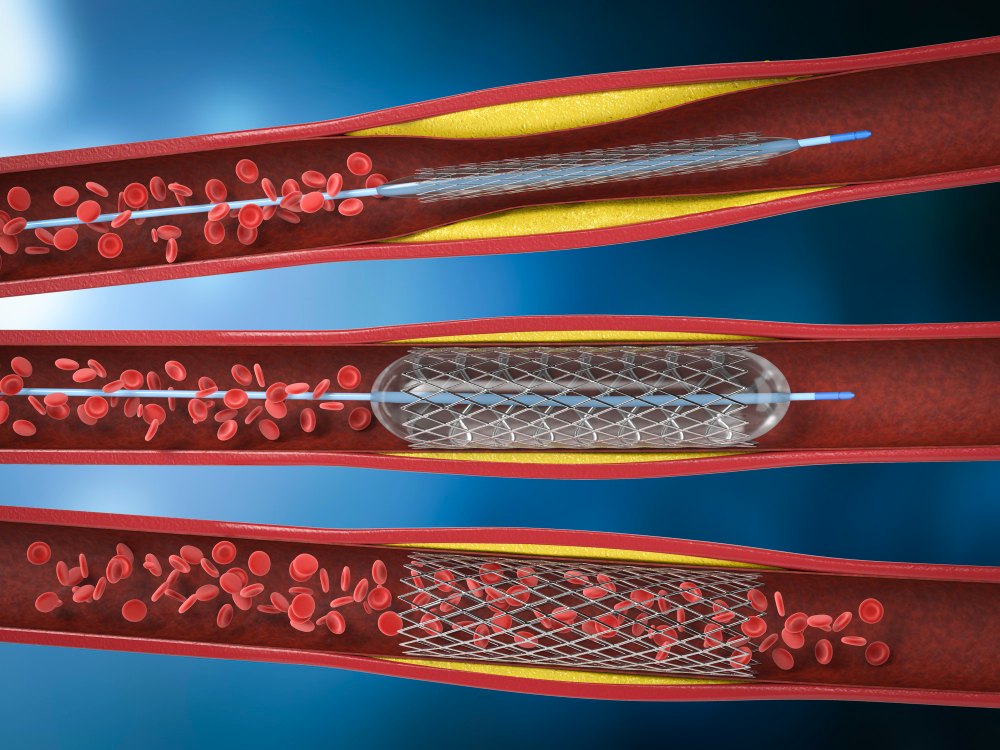 Angioplastia coronária com stent - Dr. Luiz Benittez, cardiologista intervencionista em Rondônia
