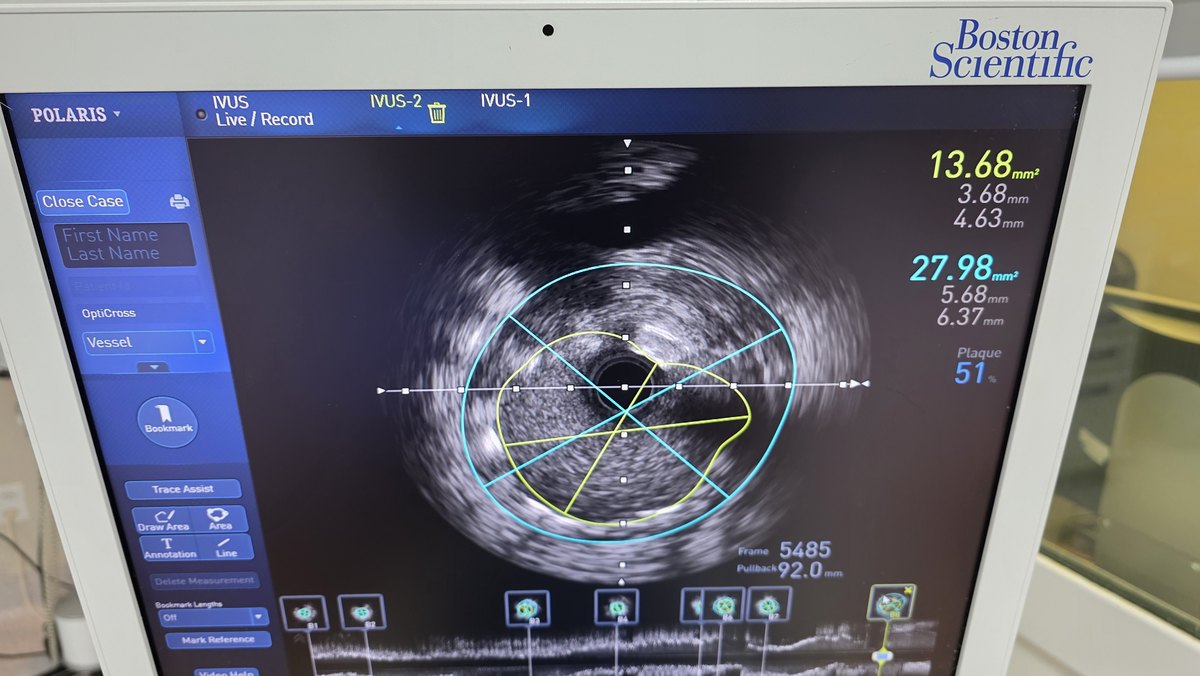 Imagem intravascular na prática - Dr. Luiz Benittez, cardiologista intervencionista em Rondônia